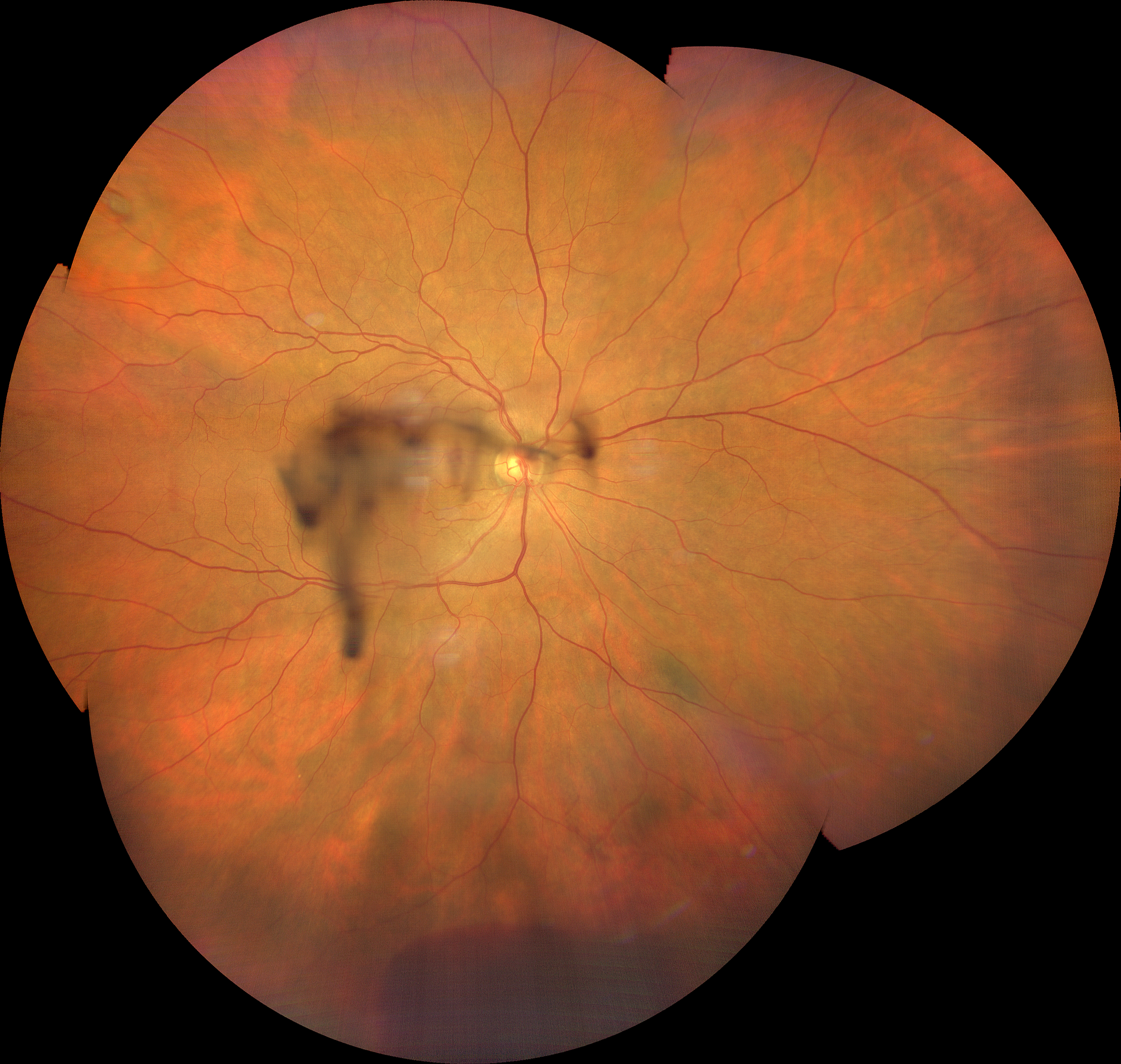 Emovitreo per rottura retinica periferica